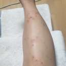 38주) 임신성 소양증