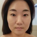 차한의원 | 천안 여드름 흉터 전문한의원 11회차 내돈내산 후기