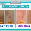 &#39;내돈내산&#39; 피부과 시술 후기: 흑자 리팟레이저 &amp; 잡티 루비레이저로 색소침착 제거