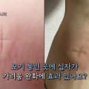 33년간 모기 연구한 교수님이 직접 말해주는 가려움 해소방법 이미지