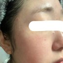 동안한의원 | 주사피부염한의원에서 6개월 동안의 치료 후기