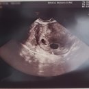 [임신일기] 6주 4일, 쌍둥이 심장 확인, 입덧의 시작, 심장내과 진료, 창원보건소 방문