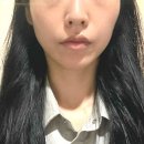 강남성형외과의원 | 윤곽주사 인모드 조합 더웨이성형외과의원 솔직 후기