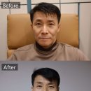 휴고성형외과의원 | [논현/뷰티] '휴고성형외과의원'에서 하나도 안아픈...5000샷'으로 아빠 주름 없애드리기! +한달 후 후기