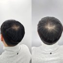 헤드샷스칼프SMP부산 이미지