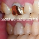 새미래치과기공소 | "어릴 때 씌운 금니가 왜 갑자기 아플까요?" 재신경치료 후 어금니 크라운 교체 치료. 부천시청역치과.