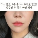 [리엔장의원 하남미사] &#34;미사 입술필러 추천&#34; 하남...궁금하신 분 꼭 보세요! 자연스러운 입술필러 후기