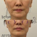 압구정 성형붓기관리 :: 다이아에스테틱 압구정점 :: 전후사진 보고 놀란 성형붓기 림프관리 후기