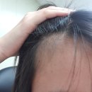 리아앤스칼프 | [범어동SMP] 대구여성탈모 정수리, 헤어라인이 신경쓰인다면 리아앤스칼프 에서 고민해결해보세요