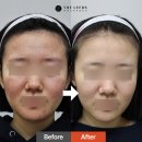 더퍼스트피부과의원 | 대구 붉은 여드름 레이저 시술 더리즈의원 후기 동성로 피부과