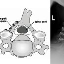 경추 척수증 (Cervical Myelopathy) 이미지