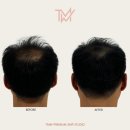 탈모왕수원 이미지
