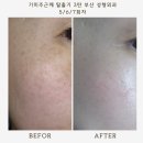 [부산 하단]기미주근깨 탈출기 3탄 : 성형외과 복합 레이저 내돈내산후기 5/6/7회차