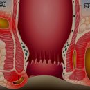 항문직장농양 항문통증의 원인과 증상 이미지