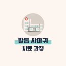 에스앤드 | 아이 발톱 사마귀 치료 후기 (냉동치료, 앤드와츠 내돈내산 직구)