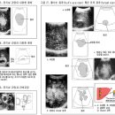 전이성 간암(metastatic tumor of liver) 이미지