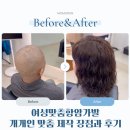 개개인 | 여성맞춤항암가발 개개인 맞춤 제작 장점과 후기