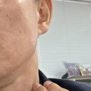 임파선이 딱딱해지는 증상 이미지