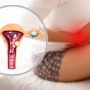 자궁내막 용종[endometrial polyp] 이미지