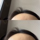 산후탈모 탈모세럼 여성탈모 세라지NMN 전후사진 있음