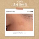 오아로피부과의원 | 수네씨의 리얼 흑자 제거기 feat. 리팟레이저