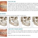 강남텐프로 | [텐프로성형]강남성형양악수술??