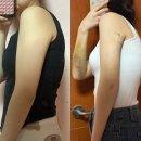 멍클린 | 수원 팔뚝 람스 당일부터 2주차까지 변화 후기 멍 붓기 통증 꿀팁