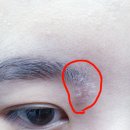 소망피부과의원 네이버블로그