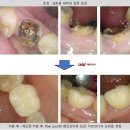 찬물에 시리고 씹으면 더 아파요 feat. 펄포토미 받고 20년, 재신경치료 후기