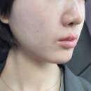 강남피부과 레이저토닝 | 주근깨 제거 1회차 후기
