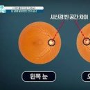 황반변성 초기 테스트 예방 이미지