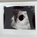 정수약국 | 세화병원 시험관 시술 1차 만에 임신 성공 후기!