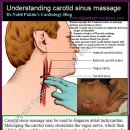 Vagus nerve stimulation therapy, carotid sinus massage - 오늘의 빅 아하!! 이미지