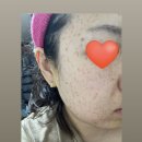 보드미 | 합정 연세보드미의원에서 편평사마귀 제거 후기｜얼굴전체 제거｜성지 인정+이지듀크림