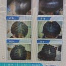 두피 탈모 아미치 0.3 수원점 이미지