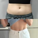 성수 지방분해주사 후기 복부 제로팻 시술받은 2주 차 다이어트 변화 전후 사진