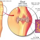 엄지발가락 아픈데 통풍 증상 같기도 한데... ㄷㄷ 이미지