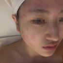 위브약국 | 화곡동 피부관리 후기｜여드름인 줄 알았던 피부, 원인을 제대로 찾은 맞춤케어