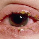 아폴로눈병[acute hemorrhagic conjunctivitis] 이미지