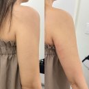 6883 | 강남 • 압구정 꽁쌤에스테틱 팔뚝 퀵슬리밍 후기