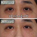 비절개 눈밑지방재배치 레이저시술후기, 시술후 바로 출근 가능!