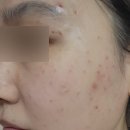 수피부비뇨기과의원 | [강남/선릉_힐 비뇨기과] 얼굴 전체 잡티 제거 후기