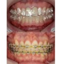 새현대치과의원 | 교정치료 중 카레 먹어도 될까요? 인비절라인 착용하고 커피 마셔도 될까요?잠실새내 교정치과