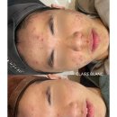 끌레르블랑 | 광교 여드름 압출 잘하는 피부관리실, 끌레르블랑 후기 공개