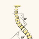 척추측만증은 꼭 치료해야 하나요? 이미지