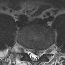 mri,사진 판독좀 부탁드립니다. 이미지