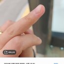 가루개로 | 2년 고생한 조갑하사마귀 완치과정(+발바닥)