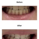 서울투에잇치과의원 | 신사 레브치과 원데이 치아미백 3회 연속으로 받아본 후기