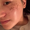 깨도독 | 압구정 루나의원 루비레이저 | 엄청 진한 주근깨 박멸 후기