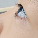 김안과 앞 횡단보도 | [누네안과병원 대구점] 6세 양안 안검내반 수술후기 당일퇴원 도움되는 준비물 오준호원장님